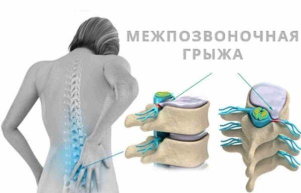 Выпячивание грыжи в спинномозговой канал способствует сдавливанию спинного мозга, вызывая этим онемение или парализ конечностей