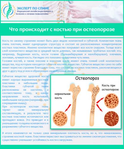 Что происходит с костью при остеопорозе