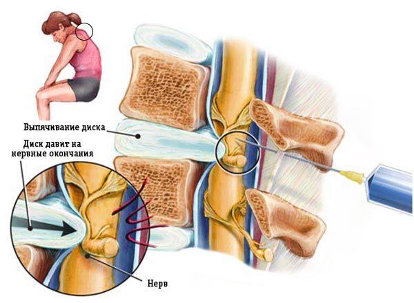 Osteochondrosis blokkoló fájdalom