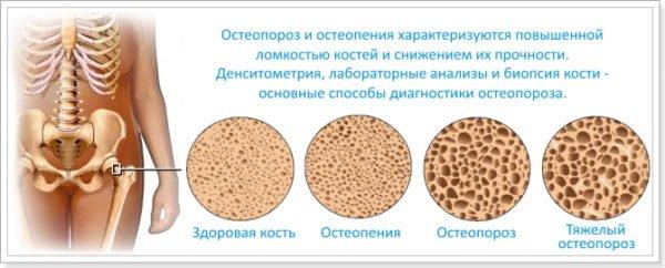 Плотность костной ткани при разных степенях остеопороза