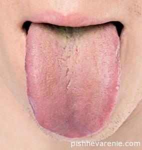 Белый налет на языке как симптом язвы желудка