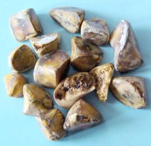 Камни - причина удаления желчного