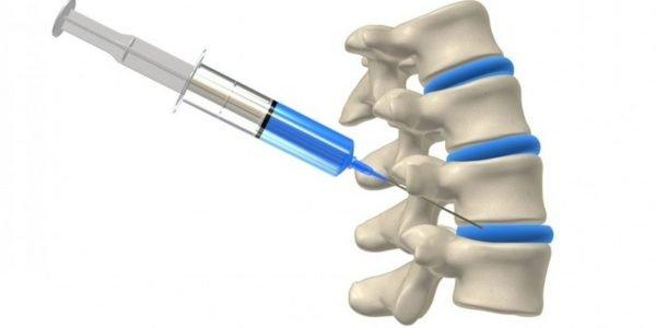 Подобная процедура не является методом лечения заболеваний спины, а лишь способом облегчить болевой синдром