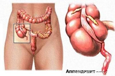 Ostryj-appendicit