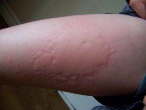 Первая помощь при аллергии в домашних условиях
