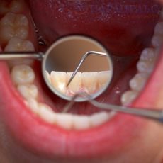 Удаление зуба в стоматологии «Парацельс»