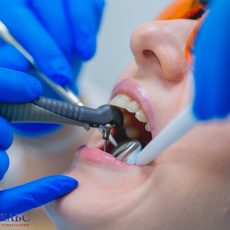 Чистка зубов в стоматологии «Парацельс»